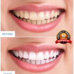Cleaner smile Whitening kits reviews 2021: is this teeth Whitening medical approved by dentists: