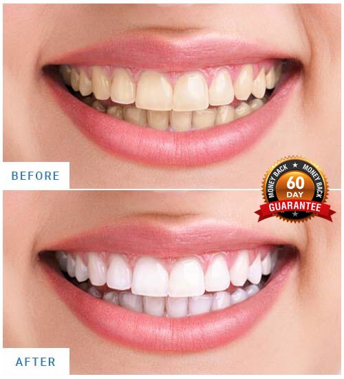 before after teeth results pic1 1