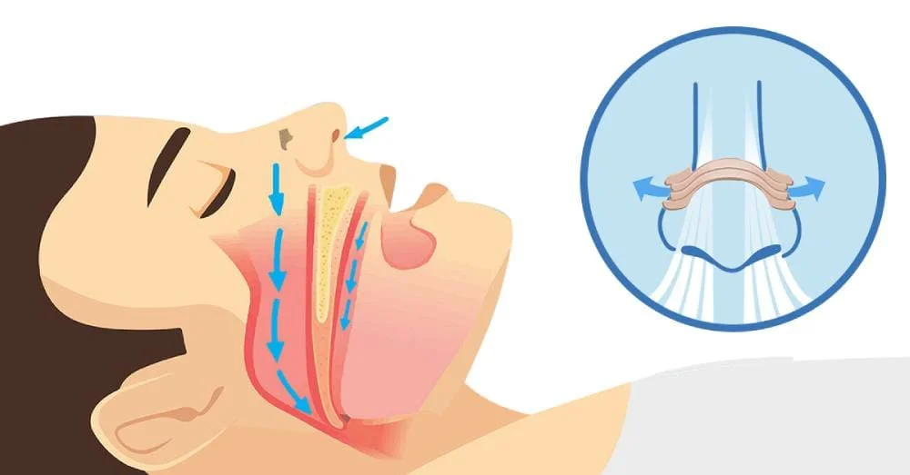 Hiloi Nasal strips reviews 2022 : Are these strips worth your money? 6 3