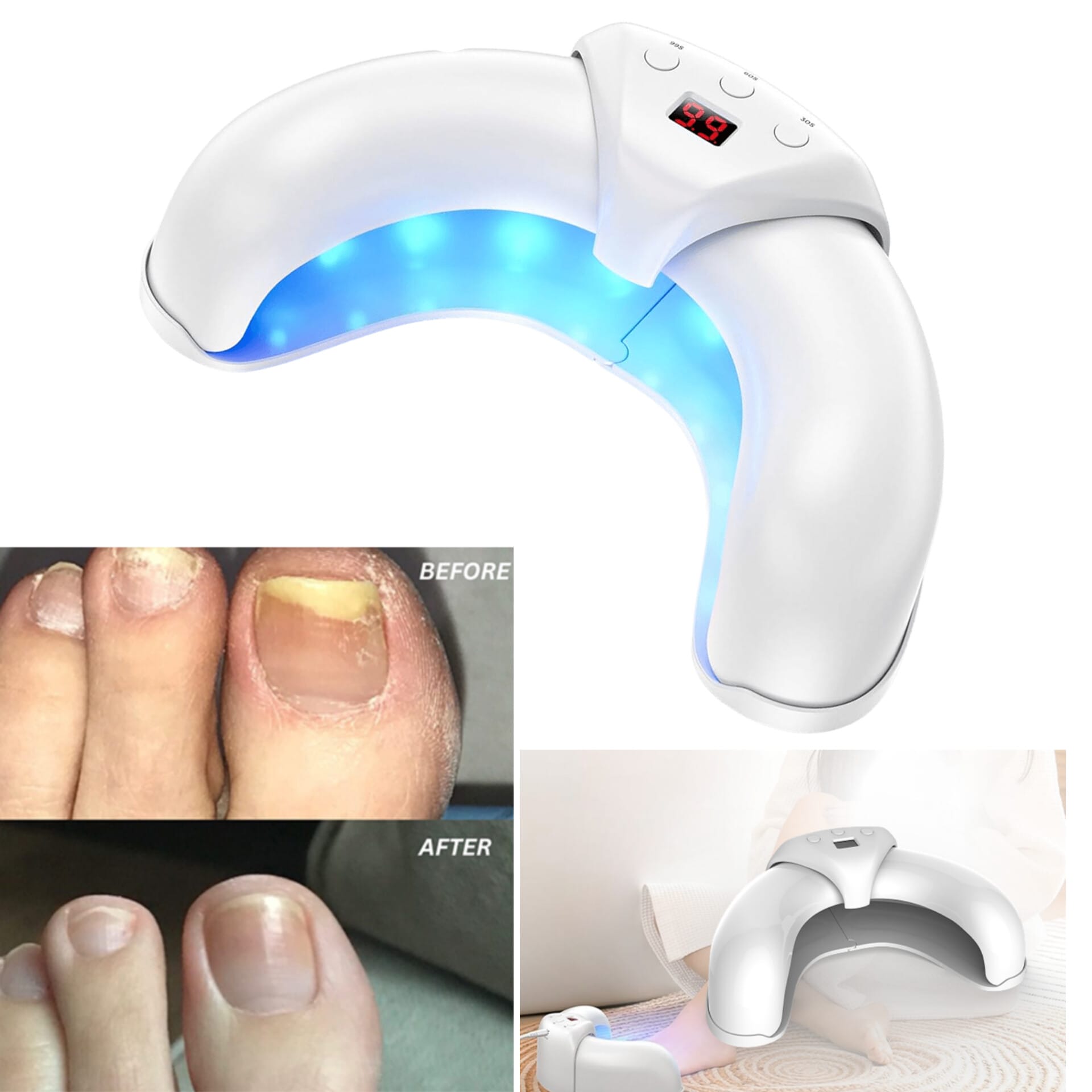 Fungabeam Nail Fungus Light Review – Does It Really Work to Eliminate Toenail Fungus Fast? 8 Fungabeam Nail Fungus Light
